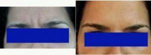 Dr Kemil Issa, MD, Dominican Republic Plastic Surgeon - 42 Year Old Woman Treated With Botox Before And After