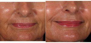 Dr Kimberly Moskowitz, MD, MS, Panama City Phlebologist - 61 Year Old Woman Treated With Restylane