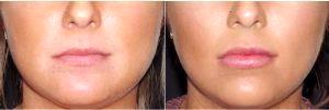 Dr Landon Pryor, MD, FACS, Rockford Plastic Surgeon - 27 Year Old Woman Treated With Juvederm