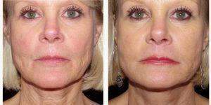 Dr Landon Pryor, MD, FACS, Rockford Plastic Surgeon - 55 Year Old Woman Treated With ArteFill