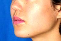 Dr Lynn Chiu-Collins, MD, San Francisco Facial Plastic Surgeon - Botox (or Dysport) For Jaw Slimming