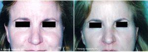 Dr Manjula Jegasothy, MD, Miami Dermatologist - Frown And Eye Lines Erased With Botox Cosmetic Injections