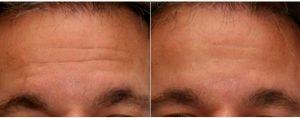 Dr Marc Cohen, MD, Philadelphia Oculoplastic Surgeon - 49 Year Old Man Treated With Botox For Forehead Lines