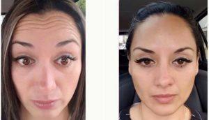 Dr Marco Carmona, MD, Mexico Plastic Surgeon - 29 Year Old Woman Treated With Botox