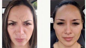Dr Marco Carmona, MD, Mexico Plastic Surgeon - 30 Year Old Woman Treated With Botox