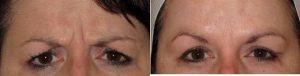 Dr Matthew Doppelt, DO, Knoxville Dermatologist - 44 Year Old Female For Brow Furrow