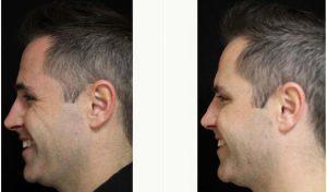 Dr Michele S. Green, MD, New York Dermatologist - 30 Year Old Man Treated With Botox