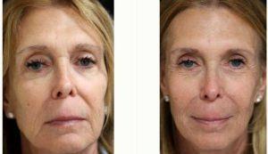 Dr Michele S. Green, MD, New York Dermatologist - 71 Year Old Woman Treated With Volbella