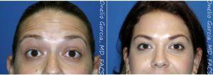 Dr Onelio Garcia Jr, MD, FACS, Miami Plastic Surgeon - 33 Year Old Woman Treated With Botox