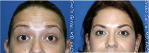 Dr Onelio Garcia Jr., M.D., Plastic Surgeon In Miami, Florida - Botox For Forehead Lines