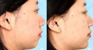Dr Peter Lee, MD, FACS, Los Angeles Plastic Surgeon - 18 Year Old Woman Treated With Restylane