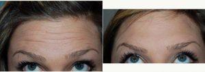 Dr Richard J. Wassermann, MD, MPH, Columbia Plastic Surgeon - 29 Year Old Woman Treated With Botox For Forehead Wrinkles