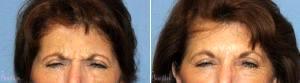 Dr Robert G. Bonillas, MD, Scottsdale Plastic Surgeon - 62 Y O Female Desired A Refreshed Look.