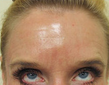 Dr Sanusi Umar, MD, Redondo Beach Dermatologic Surgeon - Botox Injection In Forehead And Glabella
