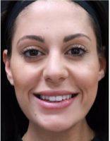 Dr Shaun Patel, MD, Miami Physician - 27 Year Old Female Treated With Botox Injection For Forehead Lines, Frown Lines, And Crow's Feet