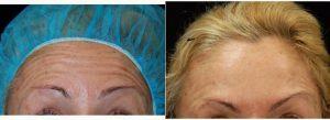 Dr Shaun Patel, MD, Miami Physician - 48 Year Old Female Treated With Botox Injections For Horizontal Forehead Lines