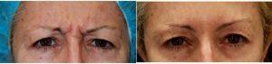 Dr Shaun Patel, MD, Miami Physician - 48 Year Old Woman Treated With Botox For Brow Furrow Glabellar Lines