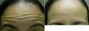 Dr Steven M. Katz, MD , Long Island Plastic Surgeon - 47 Year Old Woman Treated For Forehead Aging