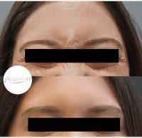 Dr TJ Tsay, MD, Tustin Physician - 20 Year Old Woman Treated With Botox In Between Eyebrows And Around The Eyes--crowsfeet