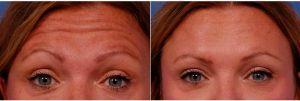Dr Thomas J. Walker, MD, Atlanta Facial Plastic Surgeon - 41 Year Old Woman Treated With Botox In The Glabella, Crows Feet, And Forehead Areas.