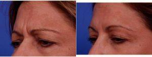 Dr Thomas J. Walker, MD, Atlanta Facial Plastic Surgeon - 51 Year Old Woman Treated With Botox, Treatment Areas Include Glabella