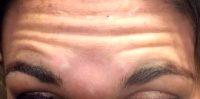 Dr Todd Christopher Hobgood, MD, Phoenix Facial Plastic Surgeon - 18 Year Old Woman Treated With Botox