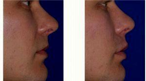 Dr Victor Lacombe, MD, Santa Rosa Facial Plastic Surgeon - 30 Year Old Male Treated With Juvederm VOLBELLA Before & After