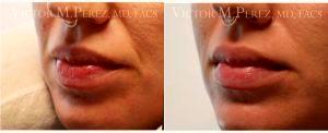 Dr Victor M. Perez, MD, FACS, Kansas City Plastic Surgeon - 28 Year Old Woman Treated With Restylane