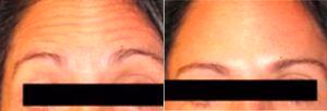 Dr Wayne Wertheim, MD, Long Island Physician - 32 Year Old Woman Treated With Botox For Forehead Lines