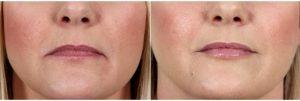 Dr William Marshall Guy, MD, The Woodlands Facial Plastic Surgeon - 54 Year Old Woman Treated With Juvederm To Her Lips And Marionette Lines
