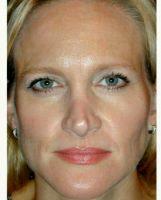 Dr. Adam Scheiner, MD, Tampa Oculoplastic Surgeon - 35 Year Old Woman Treated With Botox Browlift
