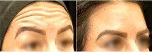 Dr. Alex Eshaghian, MD, PhD, Encino Physician - 25 Year Old Woman Treated With Botox For Forehead Wrinkles