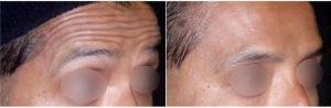 Dr. Alex Eshaghian, MD, PhD, Encino Physician - 40 Year Old Man Treated With Botox For Forehead Lines