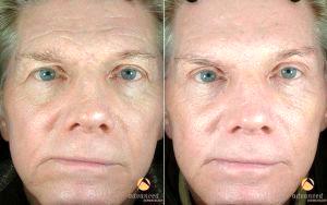 Dr. Amy Forman Taub, MD, Chicago Dermatologic Surgeon - Male Patient Treated With BOTOX® Cosmetic, Perlane® Sculptra®