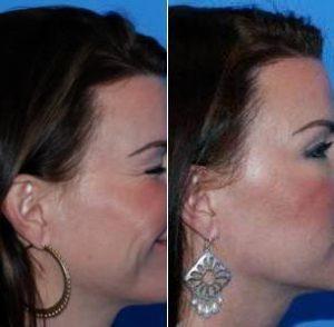 Dr. Anand G. Shah, MD, San Antonio Facial Plastic Surgeon - Caucasian Female Treated For Crows Feet