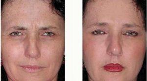 Dr. Anna Petropoulos, MD, FRCS, Boston Facial Plastic Surgeon - Botox