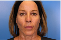 Dr. Ava Shamban, MD, Santa Monica Dermatologic Surgeon - Treatment Of Fine Lines, Wrinkles, And Harsh Jawline With Botox