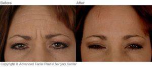 Dr. Benjamin Bassichis, Dallas Plastic Surgeon - Botox Injections For Forehead Lines And Glabella