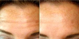 Dr. Benjamin J. Cousins, MD, Miami Beach Plastic Surgeon - 32 Year Old Woman Treated With Botox