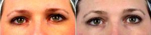 Dr. Brett S. Kotlus, MD, MS, New York Oculoplastic Surgeon - 40 Year Old Woman Treated With Botox For Non-surgical Brow Lift
