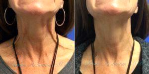 Dr. Brian Arslanian, MD, Atlanta Plastic Surgeon - 61 Year Old Woman Treated With Botox For Neck Lines