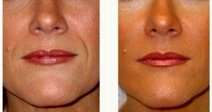 Dr. Camille Cash, MD, Houston Plastic Surgeon - 38 Year Old Woman Treated With Juvederm