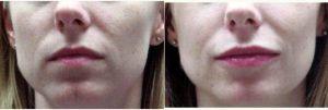 Dr. Cheryl Perlis, MD, FACOG, Highland Park Physician - Subtle Lip Enhancement Using Juvederm Dermal Filler For Lip Augmentation