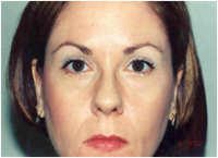 Dr. Edward E. Dickerson, IV, MD, Fayetteville Facial Plastic Surgeon - Chemical Brow Lift
