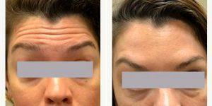 Dr. Edward Fruitman, MD, New York Physician - 36 Year Old Woman Treated With Botox