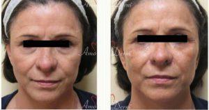 Dr. Elham Jafari, MD, Irvine Physician - 46 Year Old Woman Treated With Restylane
