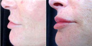 Dr. F. Victor Rueckl, MD, Las Vegas Dermatologist - 54 Year Old Woman Pre And Post 1 Syringe Of Juvederm