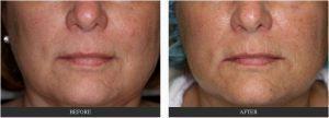 Dr. George G. Hughes III, MD, Dermatologist In Harris County, Texas - Fillers Before And After