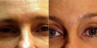 Dr. Gidon Frame, MD, Vancouver Physician - Non-surgical Eyebrow Lift With Botox