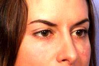 Dr. Grant Stevens, MD, Los Angeles Plastic Surgeon - Restylane To Tear Troughs (under Eyes)
